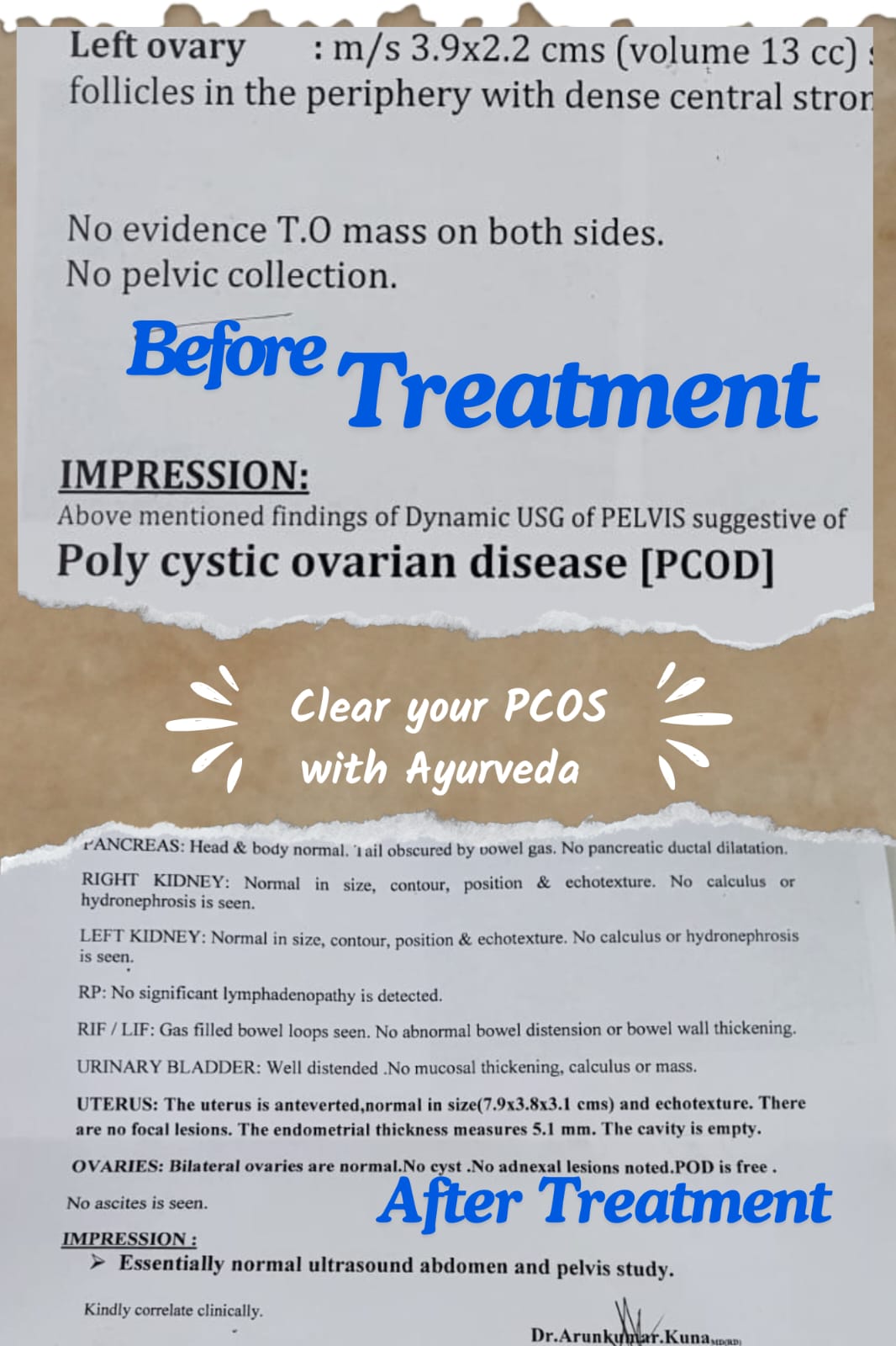 Combined ultrasound report for PCOD treatment before and after